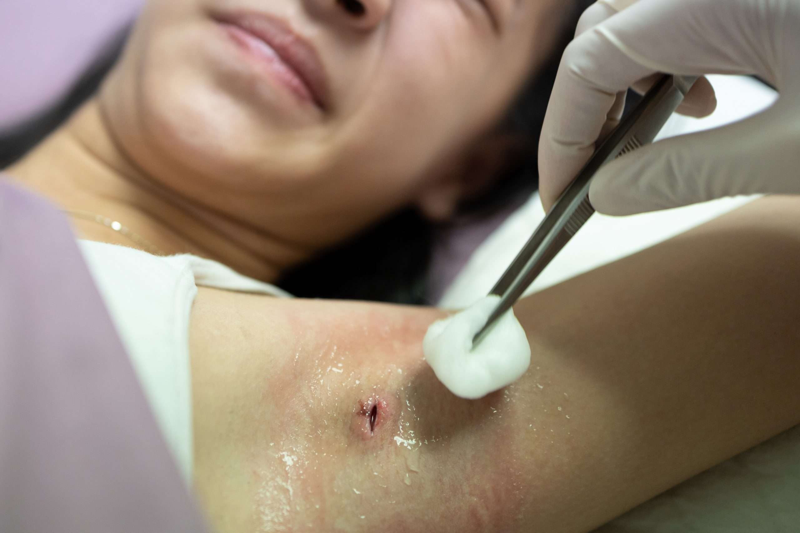 abscess being drained by an urgent care doctor