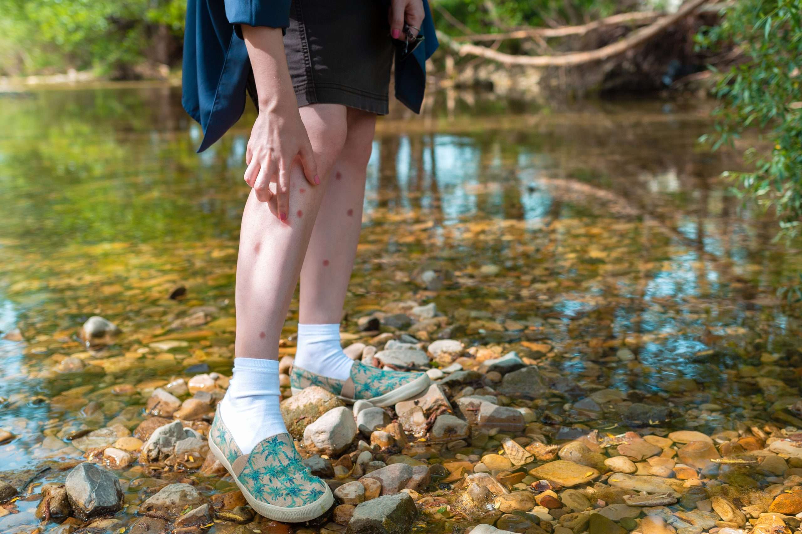 woman scratching bug bites outside by a pond